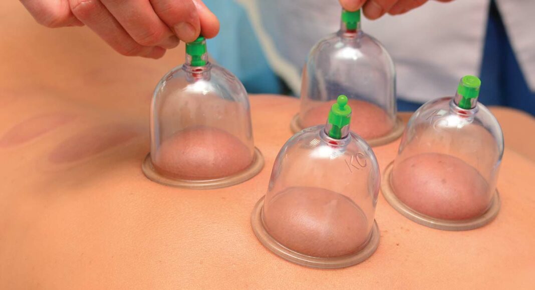 cupping therapy